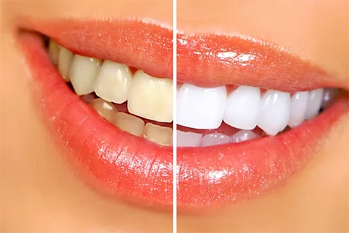 Teeth Whitening