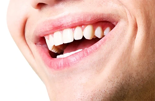 Dental tooth fillings